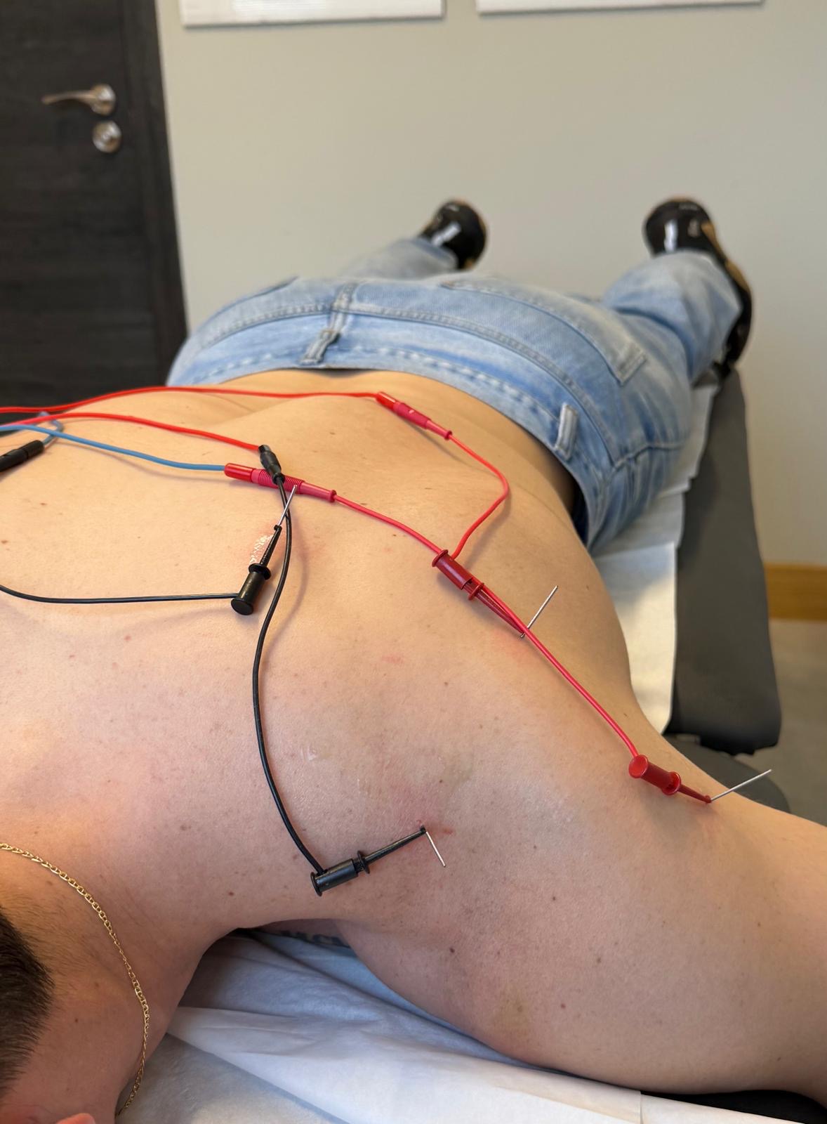 Electrólisis percutánea y punción seca en Resilient Human